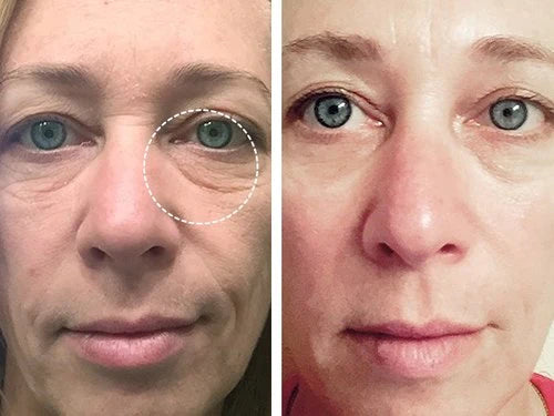 Antes y después — Catalina
